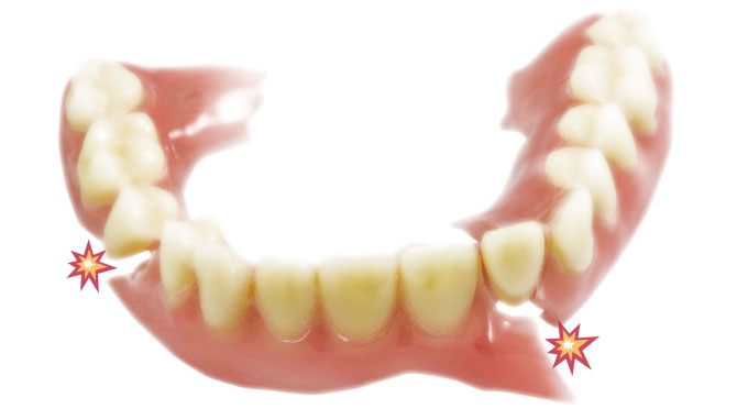Denture repair. Picture of a broken denture.