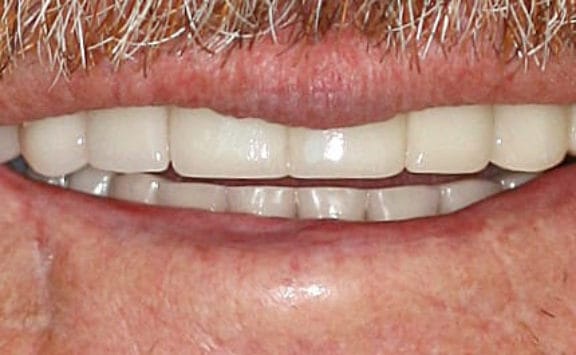 Before and after dental bridge case After