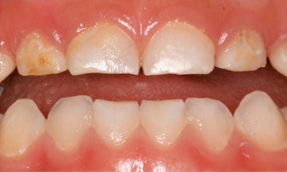 Bruxism: childhood teeth grinding