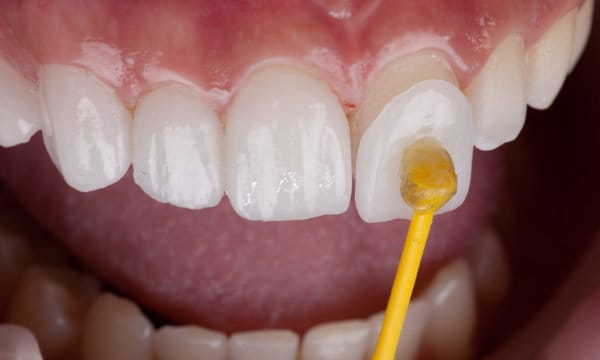 Porcelain veneer set or before and after teeth