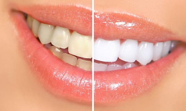 Bright smile or whitening tray
