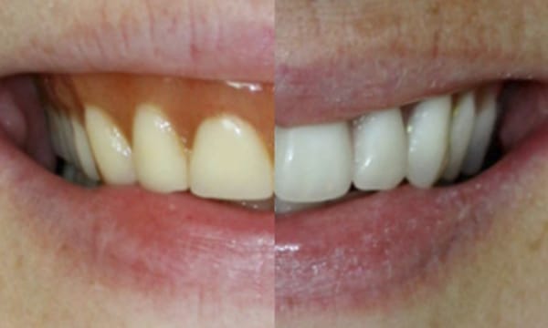 Dentures before and after gallery