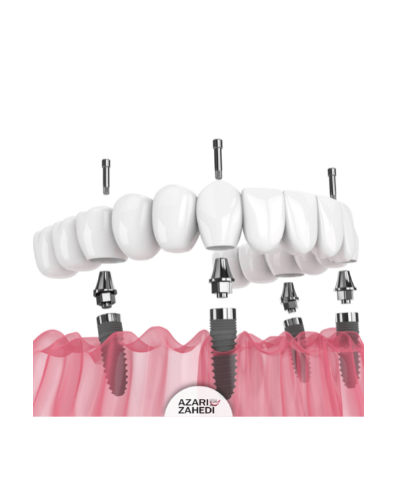 Implant-supported full-arch denture