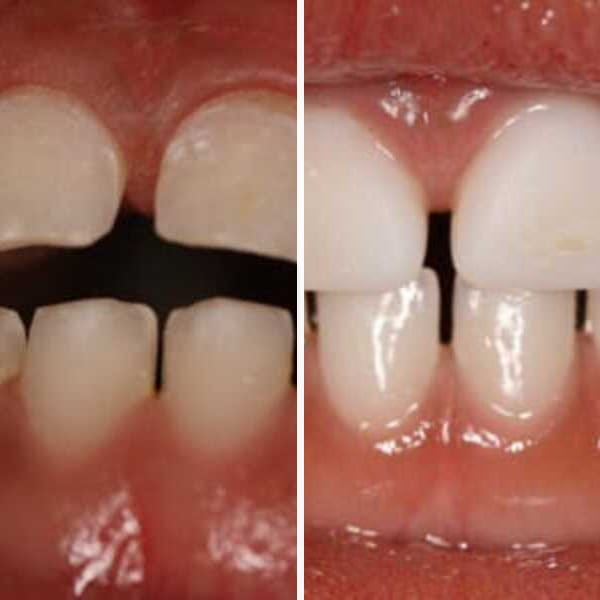 Cavity repair — before and after — Case 1