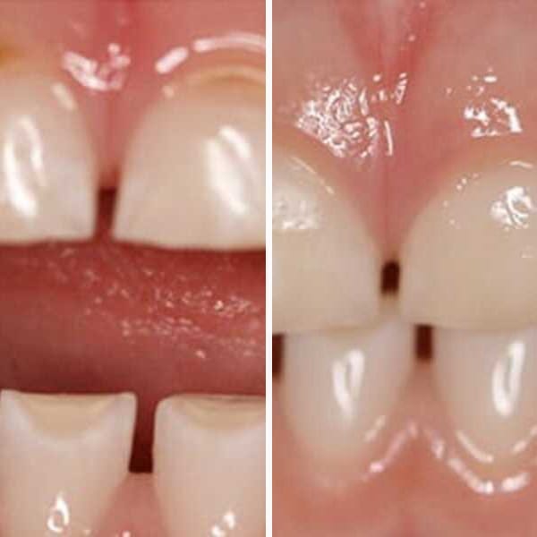 Cavity repair — before and after — Case 10