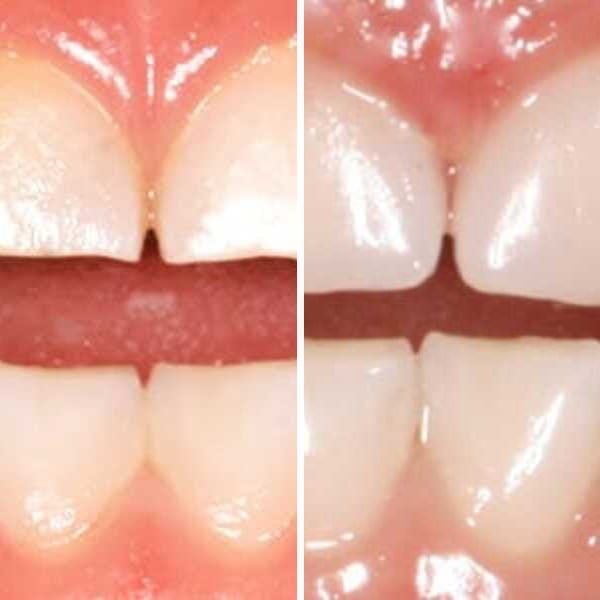 Cavity repair — before and after — Case 11