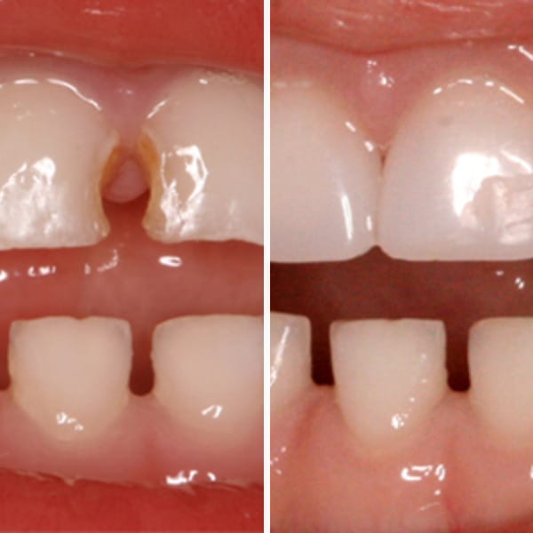 Cavity repair — before and after — Case 2