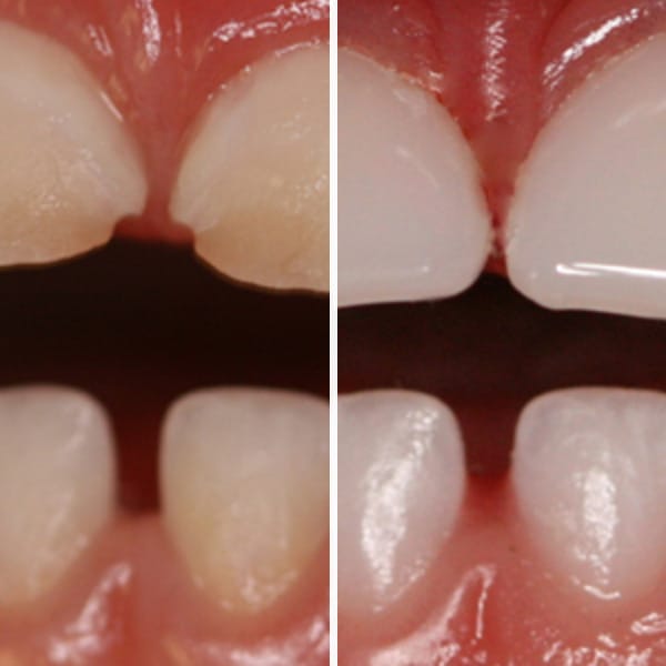 Cavity repair — before and after — Case 3