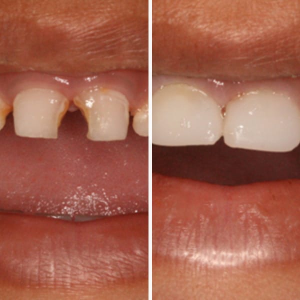 Cavity repair — before and after — Case 4