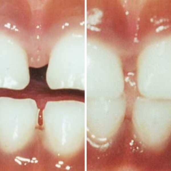 Cavity repair — before and after — Case 5