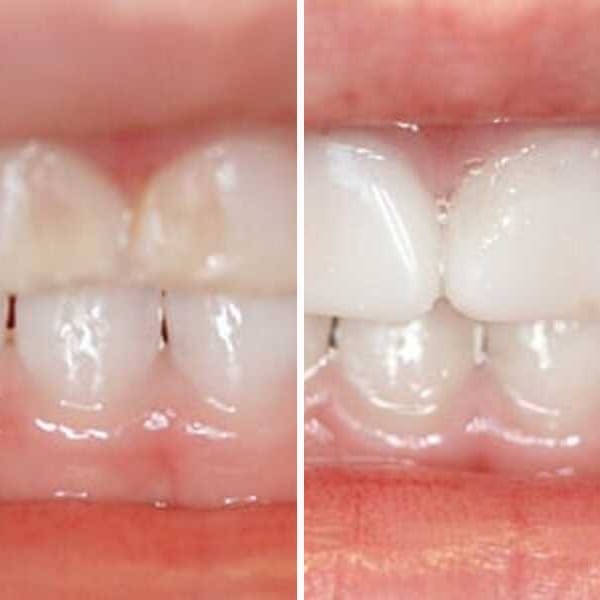 Cavity repair — before and after — Case 6