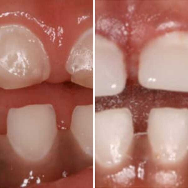 Cavity repair — before and after — Case 7