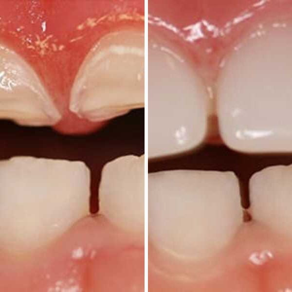 Cavity repair — before and after — Case 8