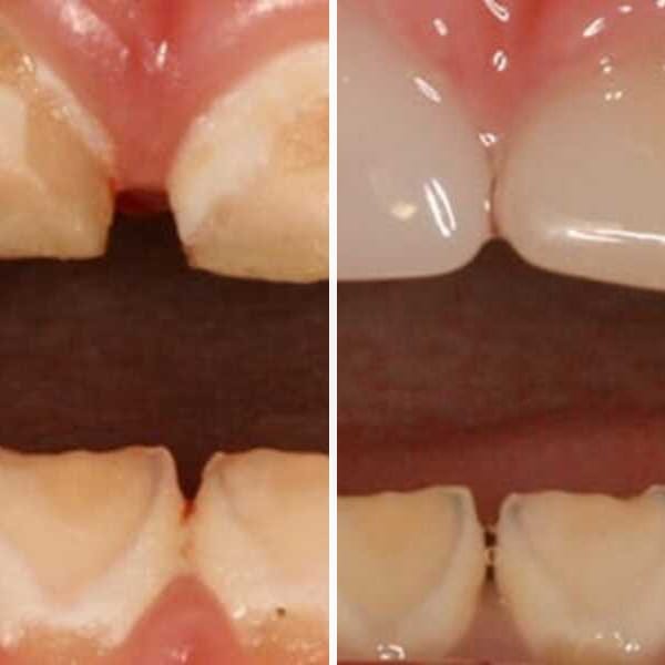 Cavity repair — before and after — Case 9