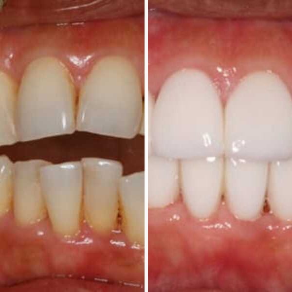 Cosmetic dentistry transformation — Case 1