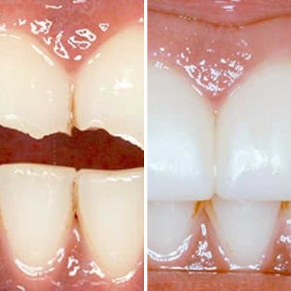 Cosmetic dentistry transformation — Case 2