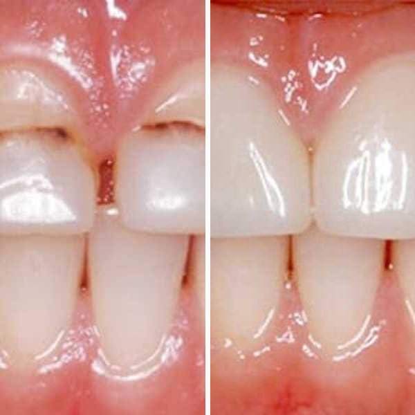 Cosmetic dentistry transformation — Case 3
