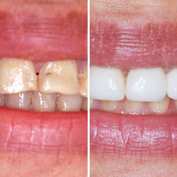 Cosmetic crown — before and after