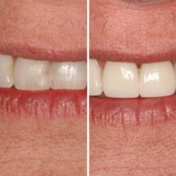 Cosmetic crowns — before and after — Case 1