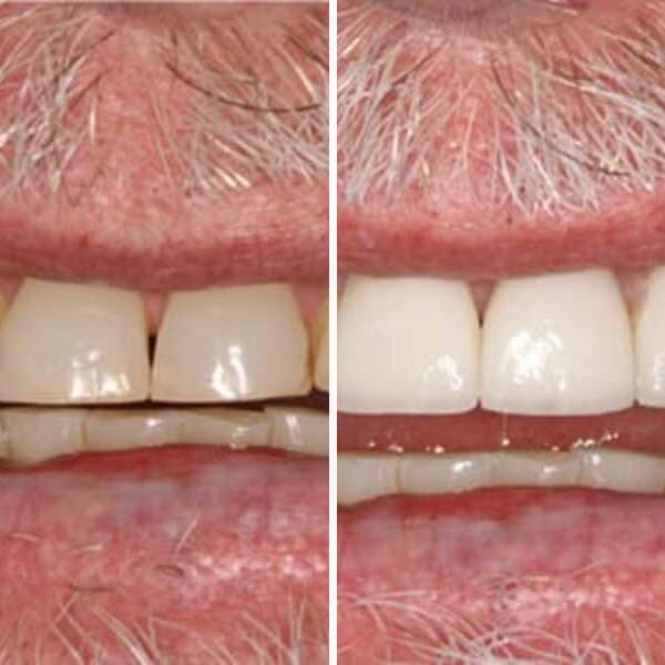 Cosmetic crowns — before and after — Case 2