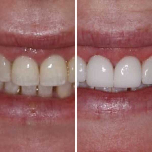 Cosmetic crowns — before and after — Case 3