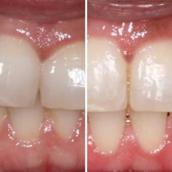 Invisalign treatment - Case 1