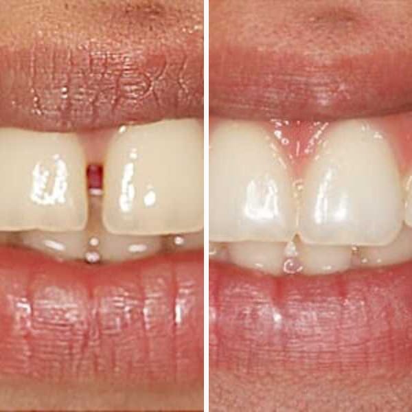 Invisalign treatment - Case 2