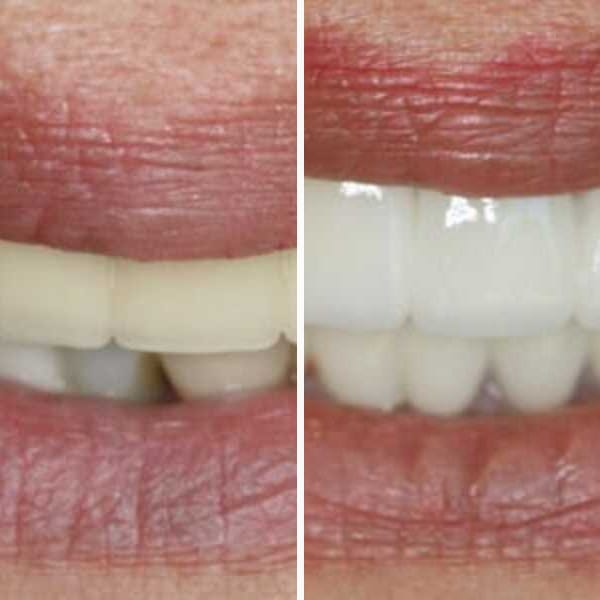 Combination case — porcelain veneers and dental implants