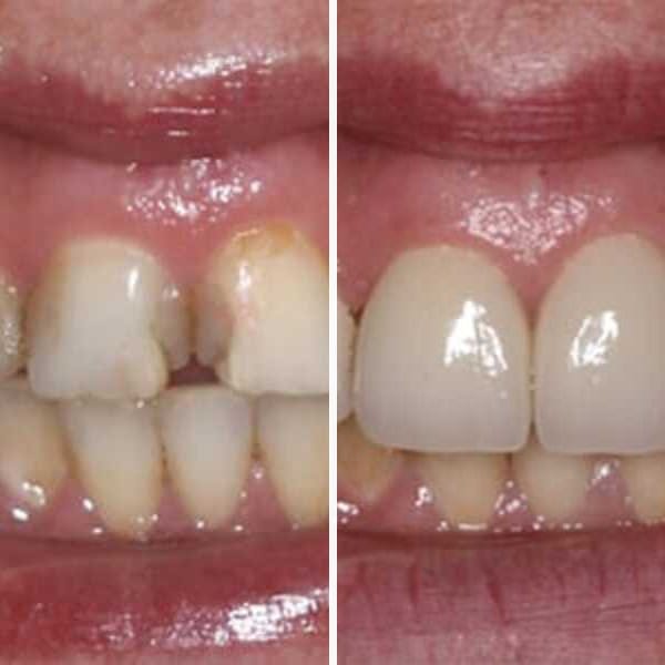 Porcelain veneers — before and after — Case 1