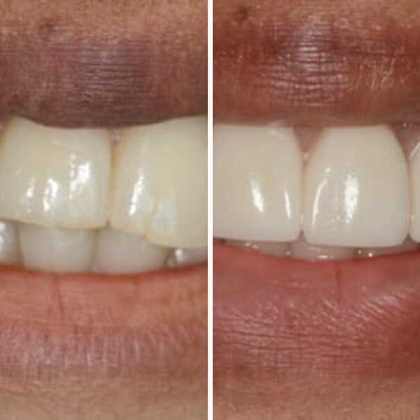 Porcelain veneers — before and after — Case 2