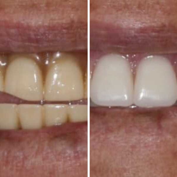 Custom denture — before and after — Case 1