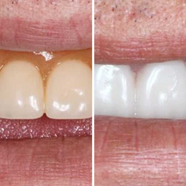 Custom denture — before and after — Case 10