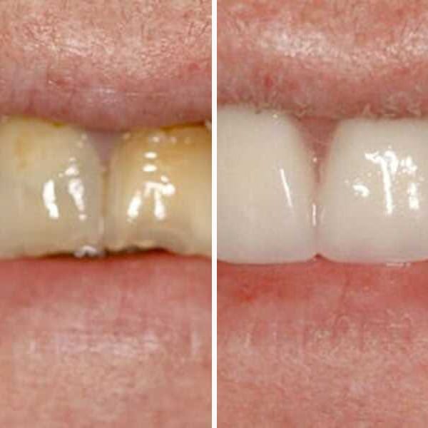 Custom denture — before and after — Case 11