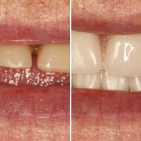 Custom denture — before and after — Case 12
