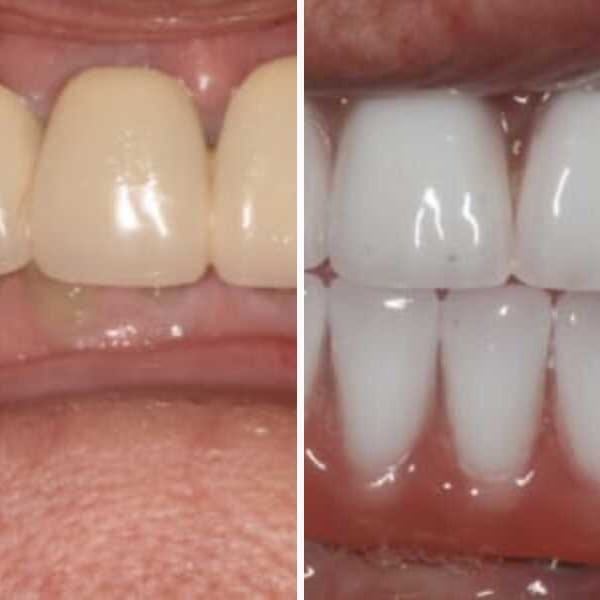 Custom denture — before and after — Case 13