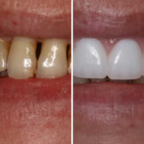 Custom denture — before and after — Case 14