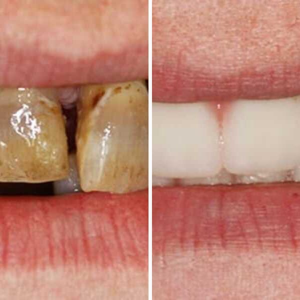 Custom denture — before and after — Case 15