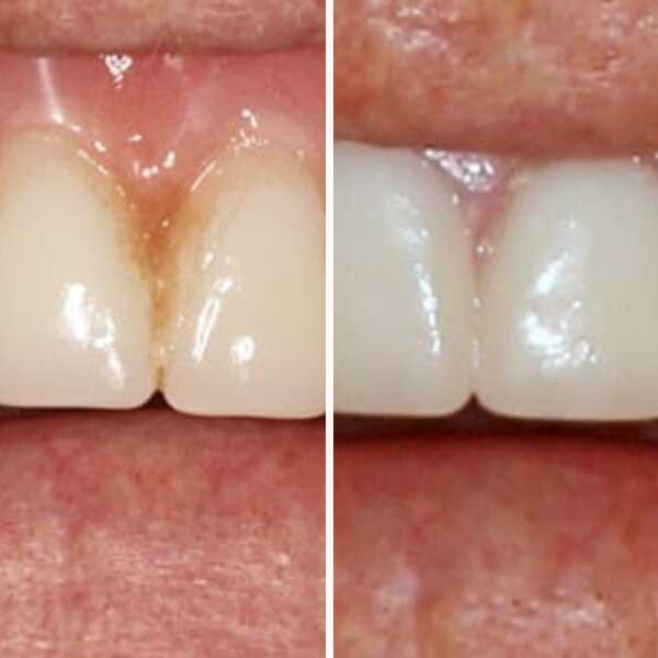 Custom denture — before and after — Case 16