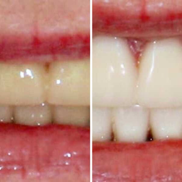 Custom denture — before and after — Case 17