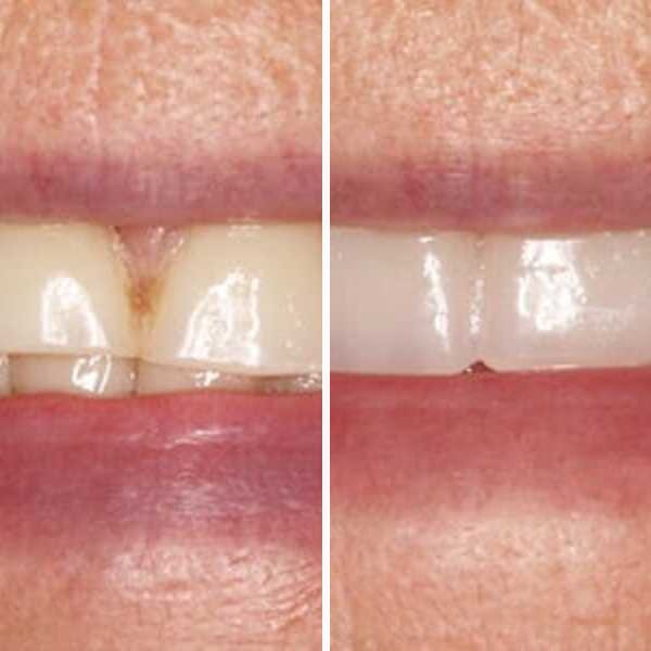 Custom denture — before and after — Case 18
