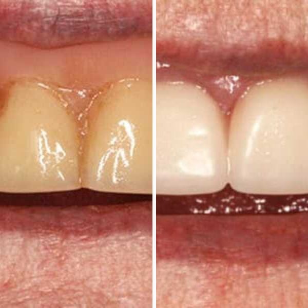 Custom denture — before and after — Case 19
