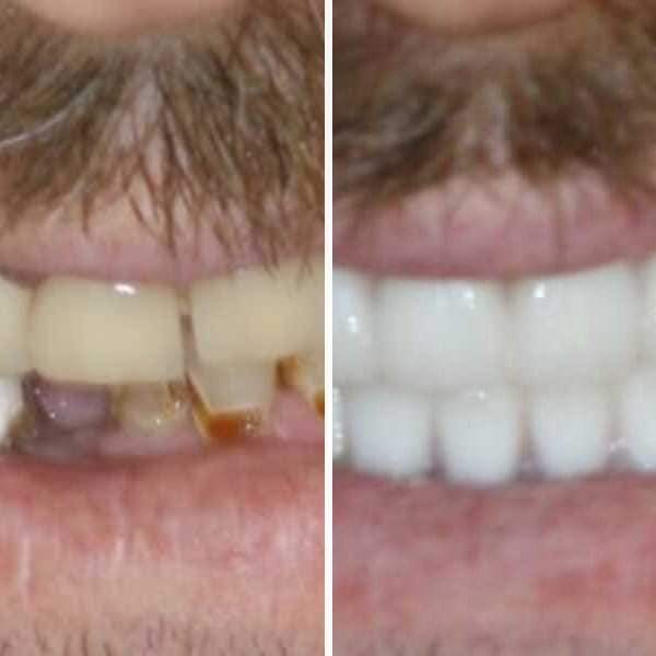 Custom denture — before and after — Case 2