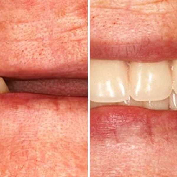 Custom denture — before and after — Case 20