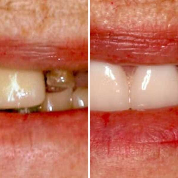 Custom denture — before and after — Case 21