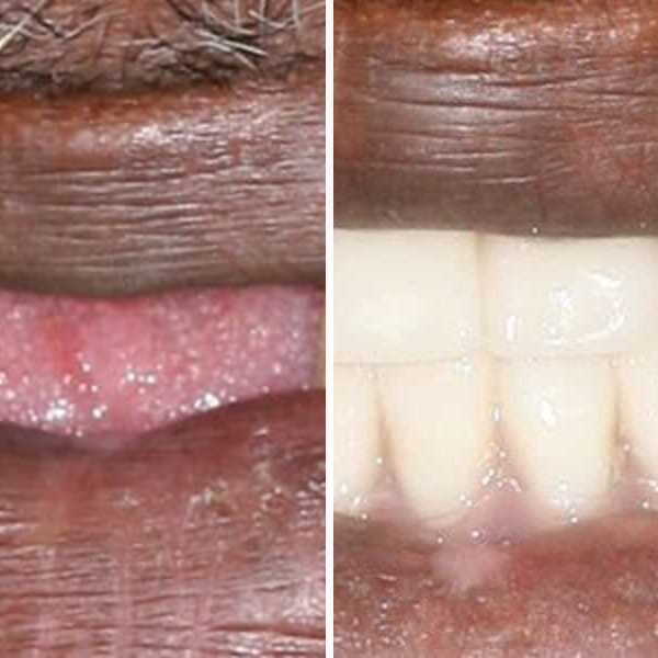Custom denture — before and after — Case 22