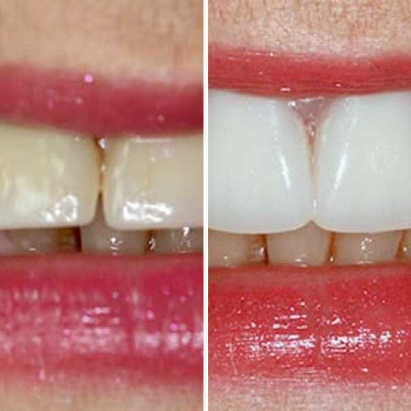 Custom denture — before and after — Case 23