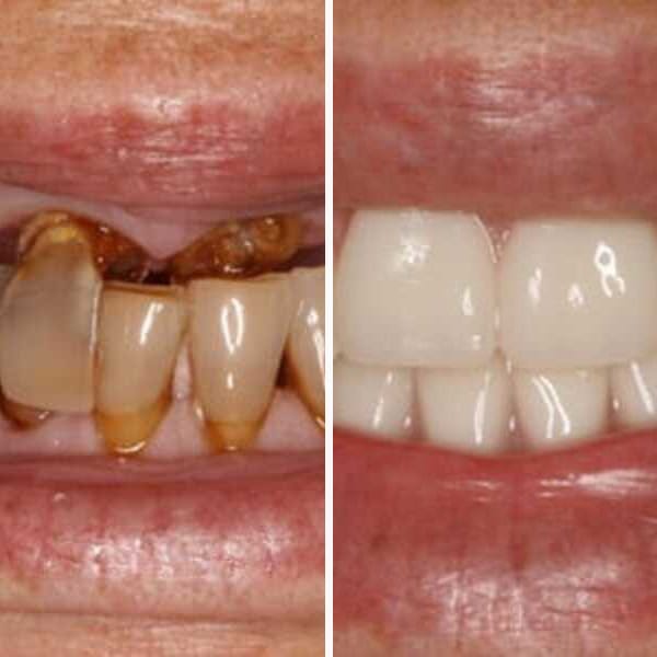 Custom denture — before and after — Case 3