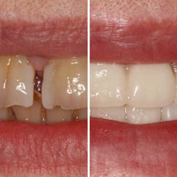 Custom denture — before and after — Case 4