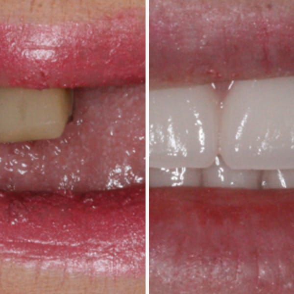 Custom denture — before and after — Case 5