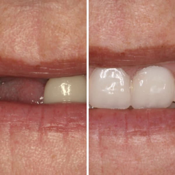 Custom denture — before and after — Case 6